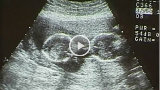 Ch_8_Sonogram_story.png