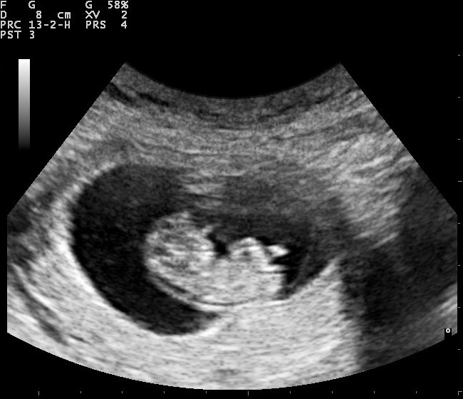 Pregnancy_ultrasound_110316153736_1538380[1].jpg
